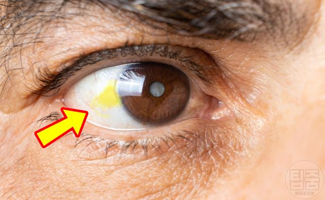 치매 초기 증상 눈 흰자 위 노란 반점
