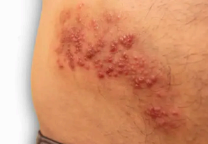 대상포진 증상 사진