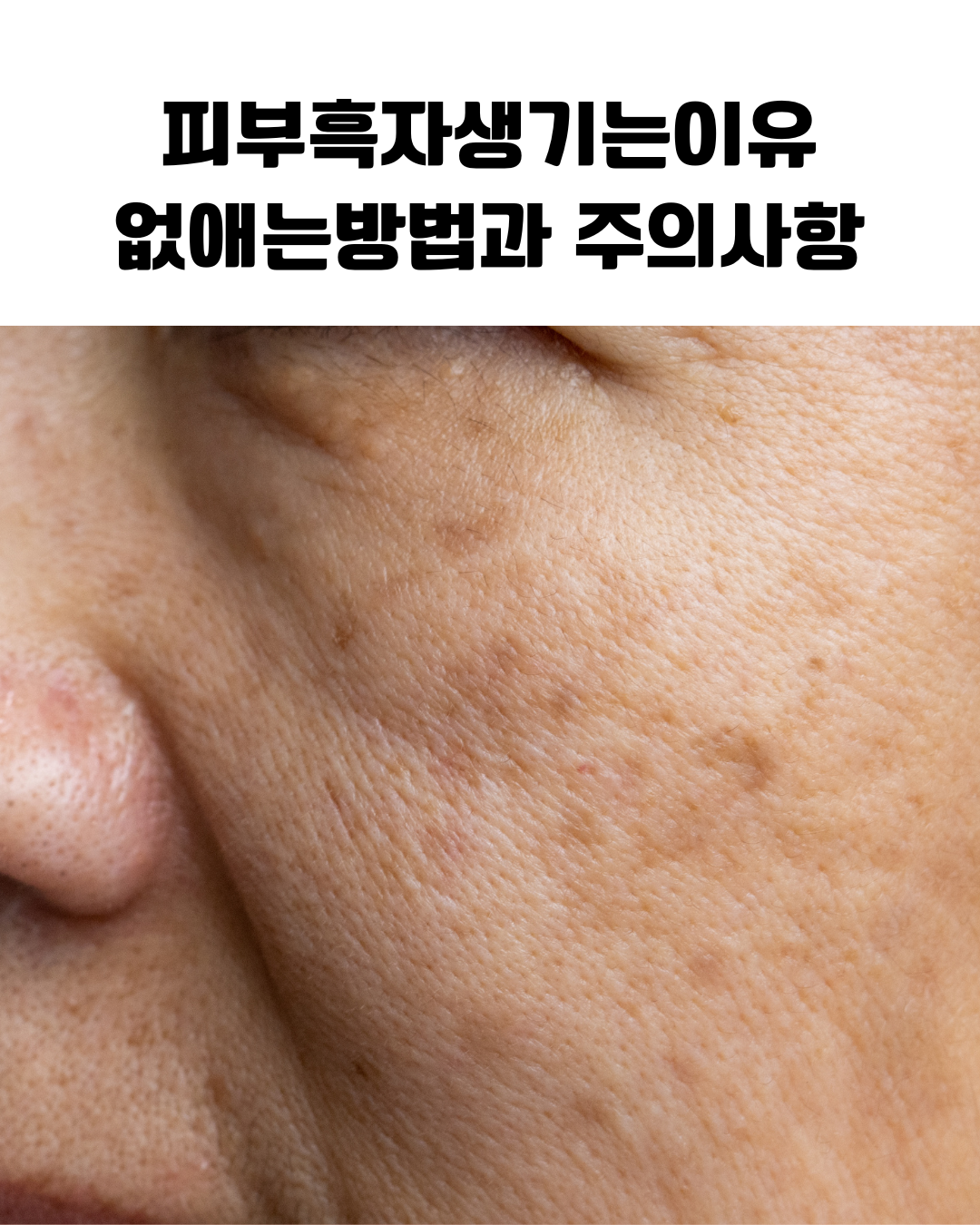피부 흑자 원인과 관리 방법 안내 이미지로 자외선 노출로 인한 멜라닌 색소 침착 과정과 홈케어 관리 요령을 정리한 피부 관리 정보 그래픽