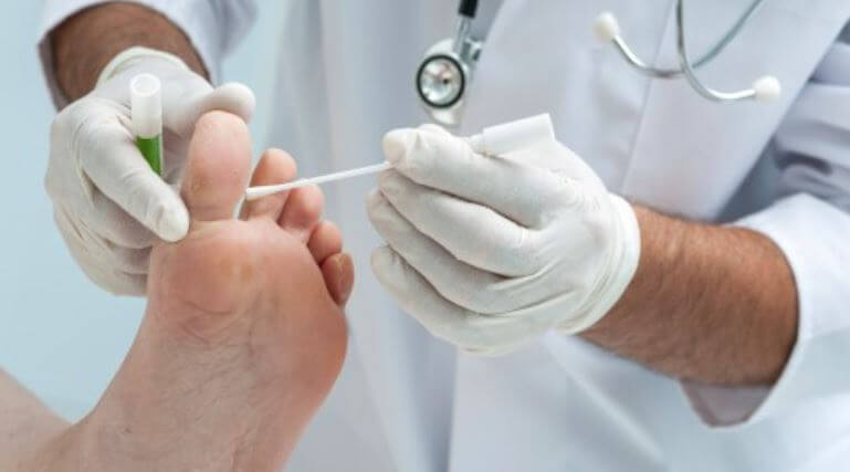 발톱 무좀 치료