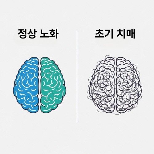 치매 초기 증상 10가지