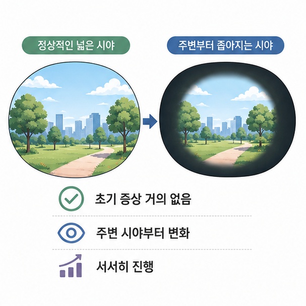 초기에는 특별한 증상이 없고 주변 시야부터 서서히 변할 수 있음을 비교한 그림