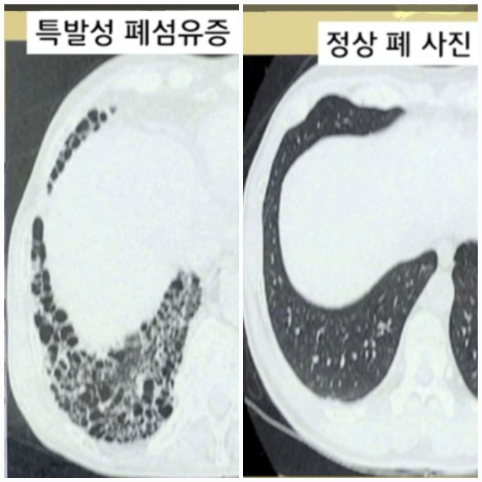 폐-CT-모양-특발성-폐섬유증