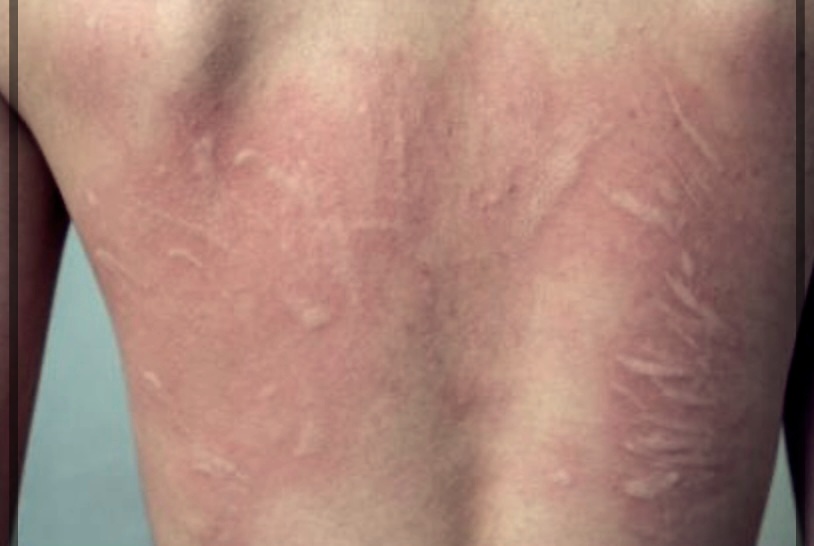 피부 기묘증 치료를 위한 실질적인 팁