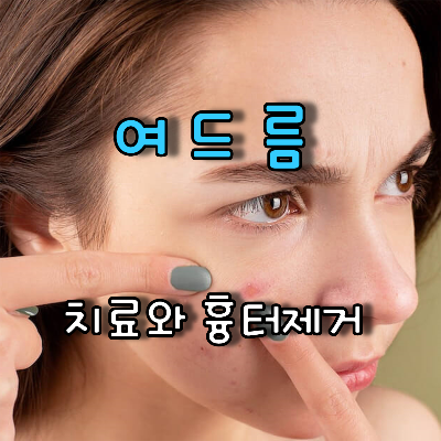 여드름