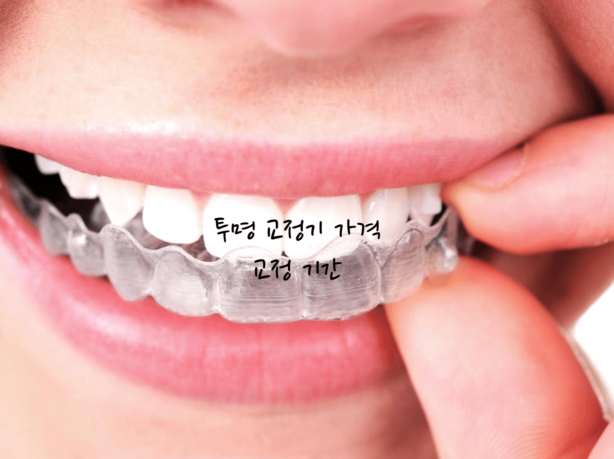 투명 교정기