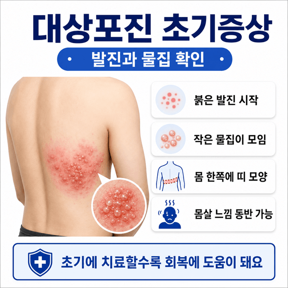 대상포진 초기증상