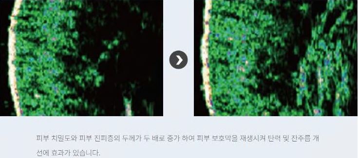 리쥬란 힐러 효과 효능