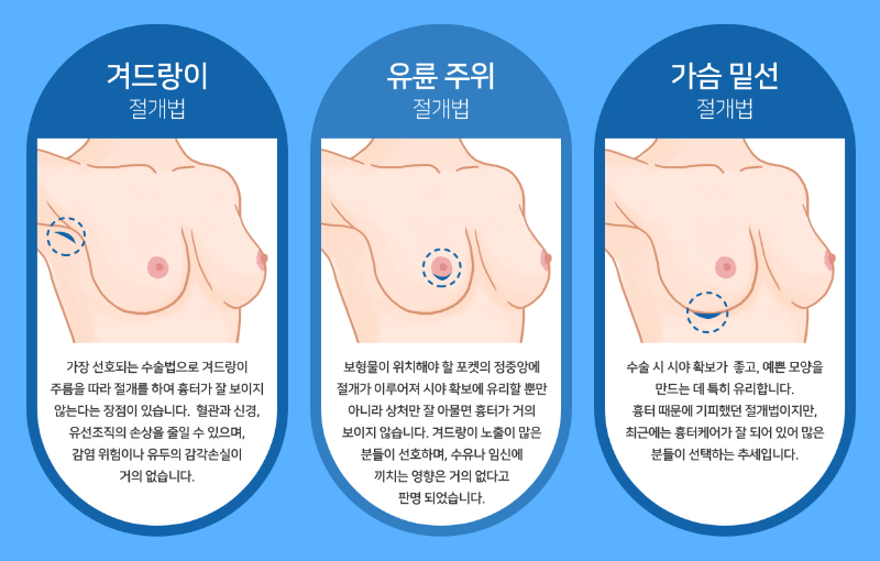 유방수술