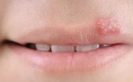 헤르페스 1형 전염과 원인