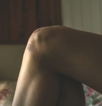 퇴행성 관절염 치료제 예방법 진단기준