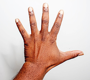 손목터널증후군-이미지