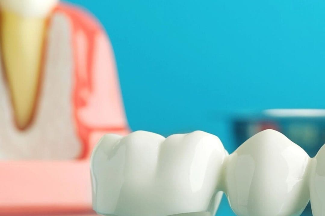 임플란트 브릿지 보철물 클로즈업 이미지