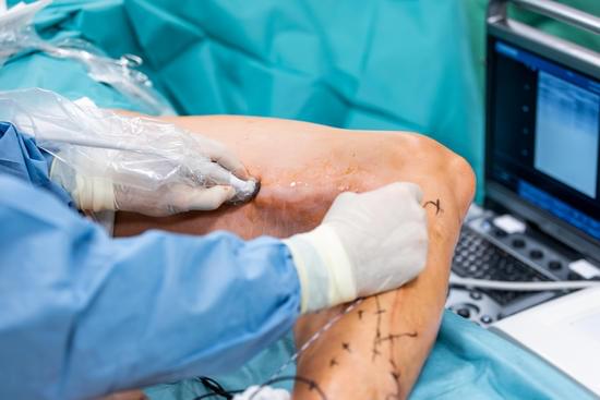 고주파 열 치료(RFA, Radiofrequency Ablation) – 하지정맥류 치료