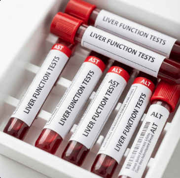 비알콜성 지방간 원인과 치료8