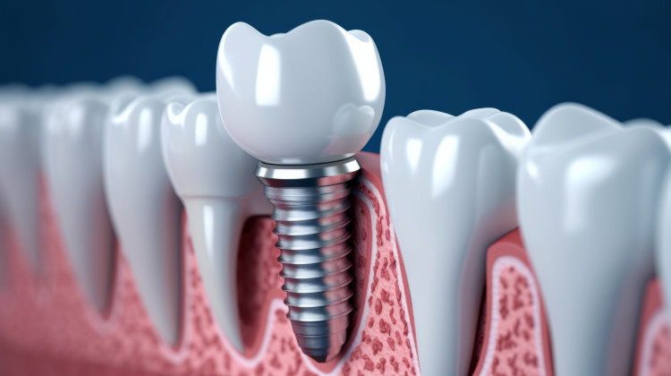어금니 임플란트 가격