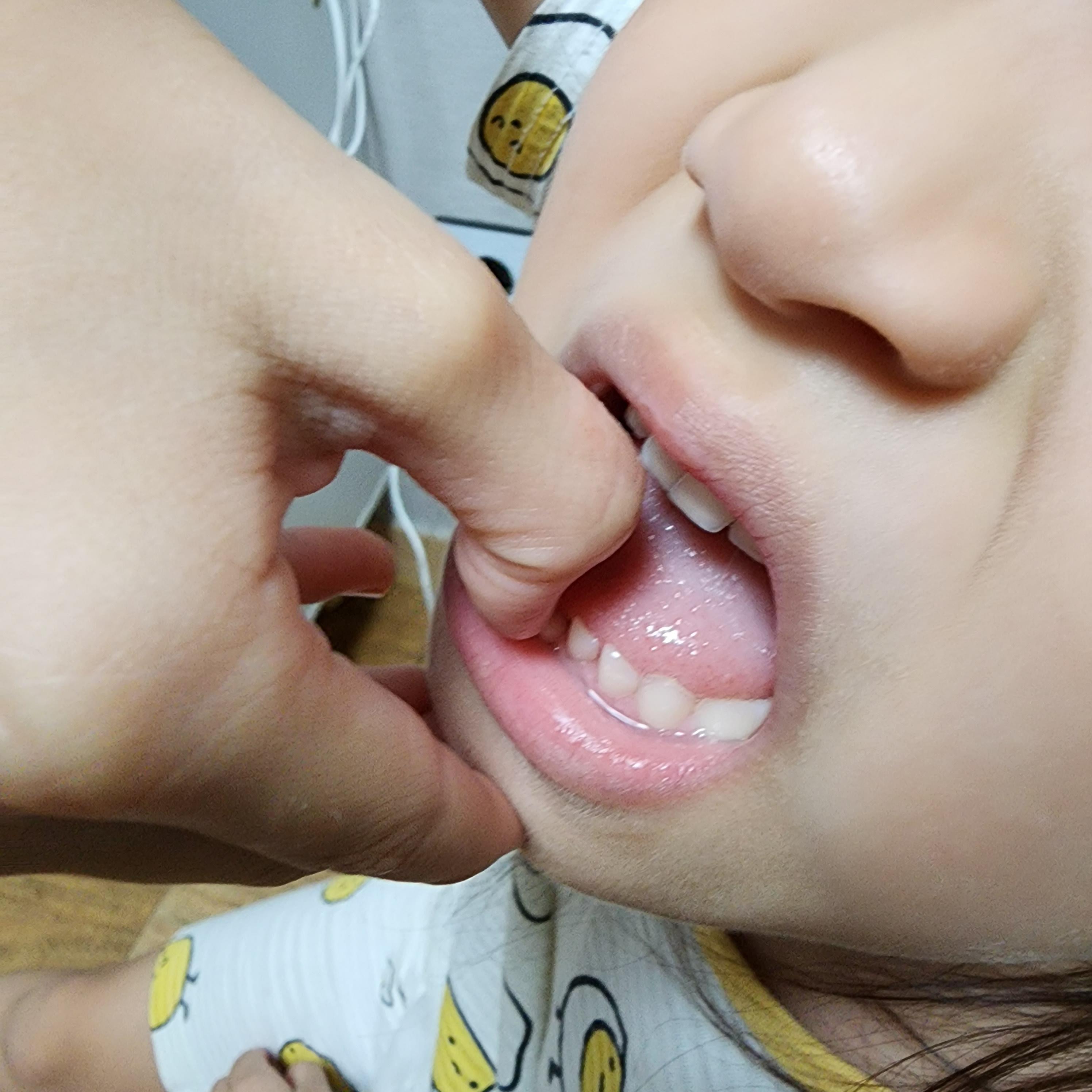 안아프게이빨뽑기