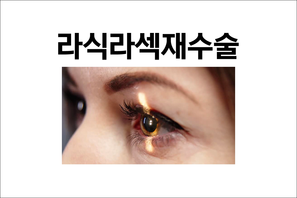 라식 라섹 후 시력교정수술 시력저하 재수술 다시 가능 여부