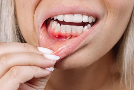 치주염(Periodontitis): 원인, 증상, 치료 및 예방