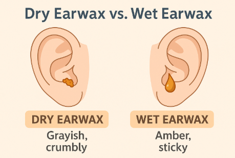 마른 귀지 vs 젖은 귀지 비교