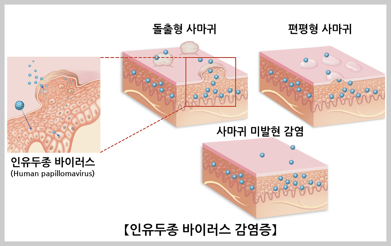 인유두종바이러스