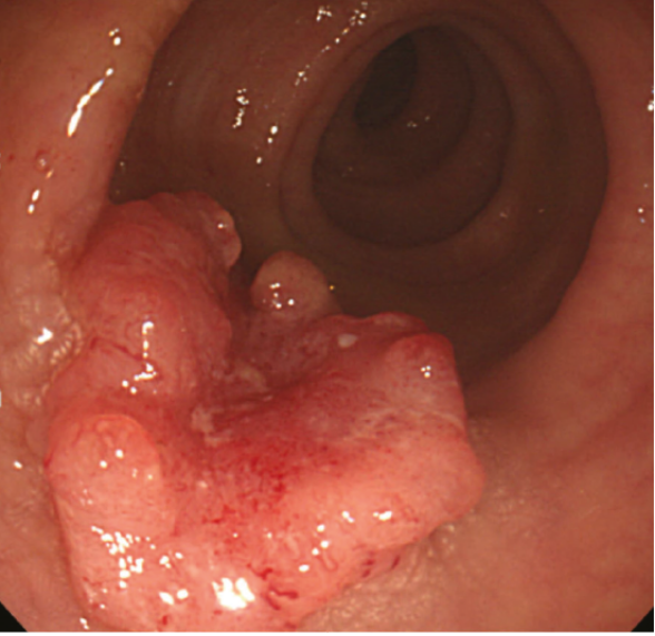 대장암 내시경사진