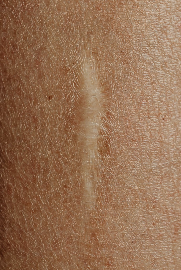 흉터