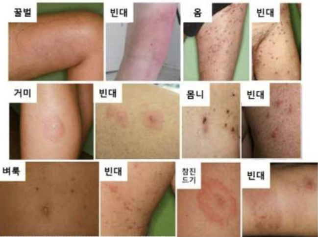 진드기물린자국,집먼지진드기물린자국,진드기물린자국증상,이불진드기물린자국,진드기퇴치제,진드기 알레르기