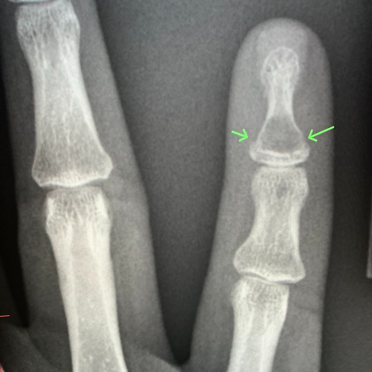 발가락 골절 완치 기간