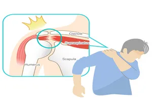 회전근개파열-치료법