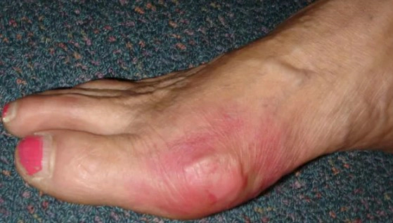 통풍에 안좋은 음식 정리