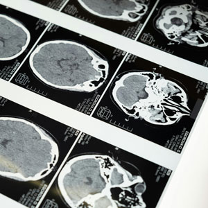 치매 검사 방법 - mri