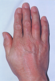 초기 증상 10가지 - 관절 발적&amp;#44; 굿모닝 내과의원 참조