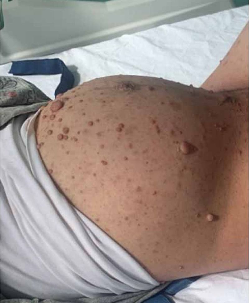 신경섬유종 초기 증상, 혹시 나도? 놓치면 안 되는 신호