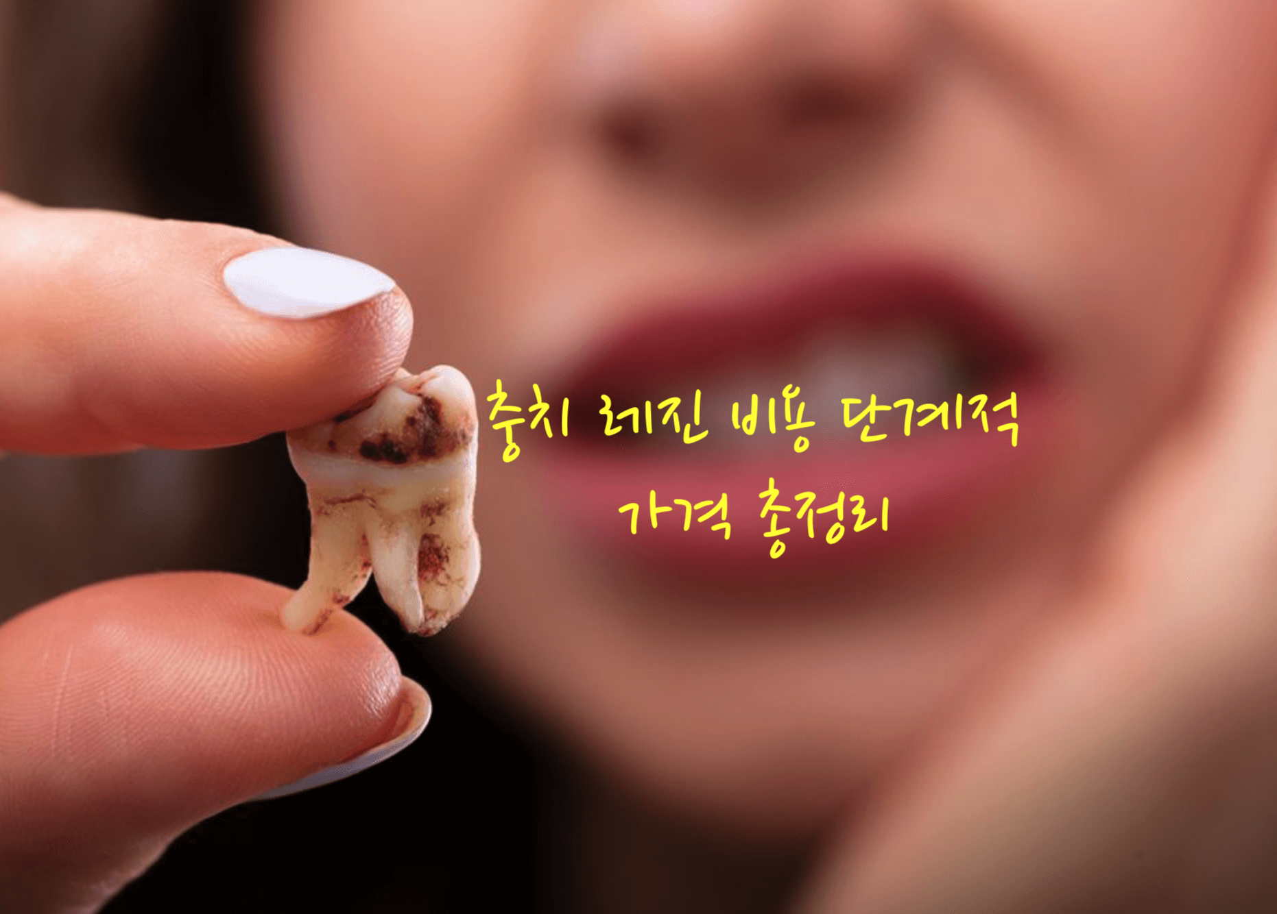 충치 레진 비용