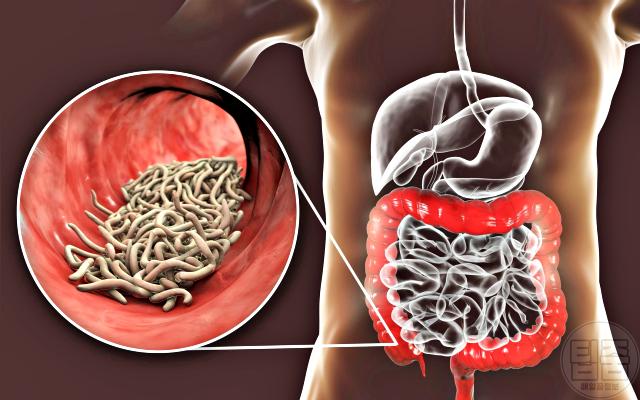 기생충 감염 증상