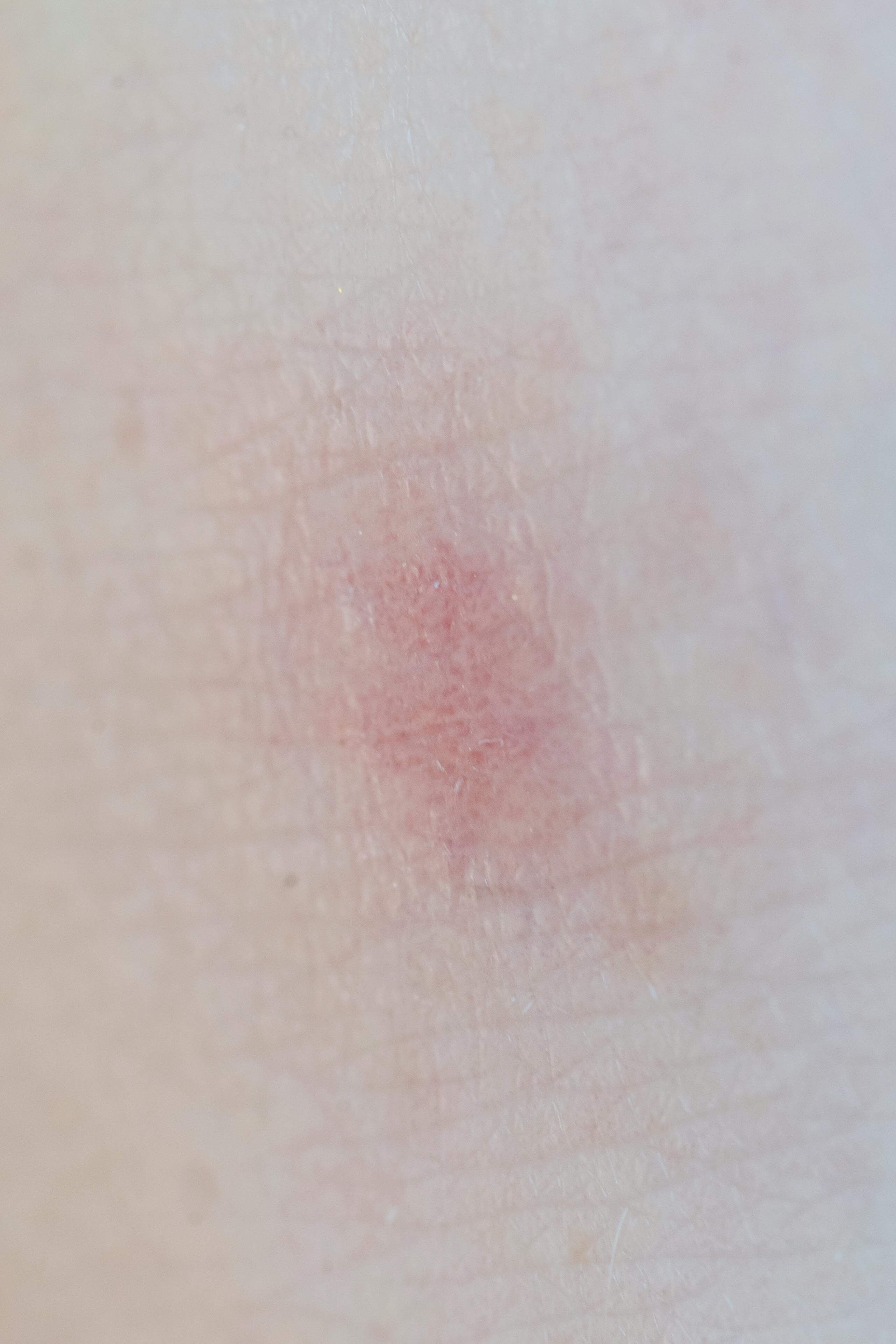 진드기 물림 증상 총정리: 가려움부터 치명적 질환까지 꼭 알아야 할 정보