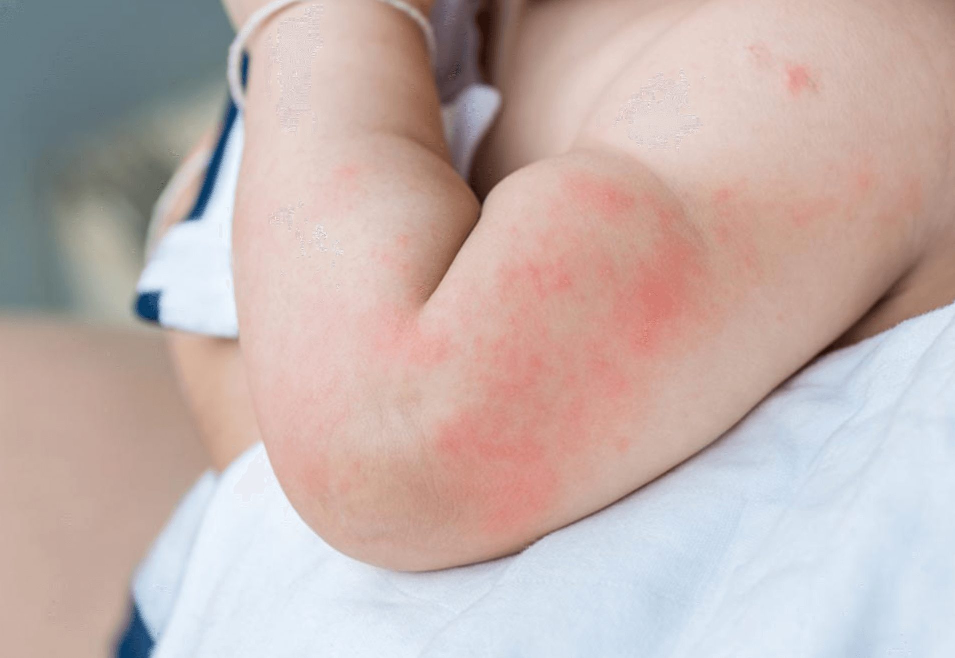 팔-좁쌀-두드러기