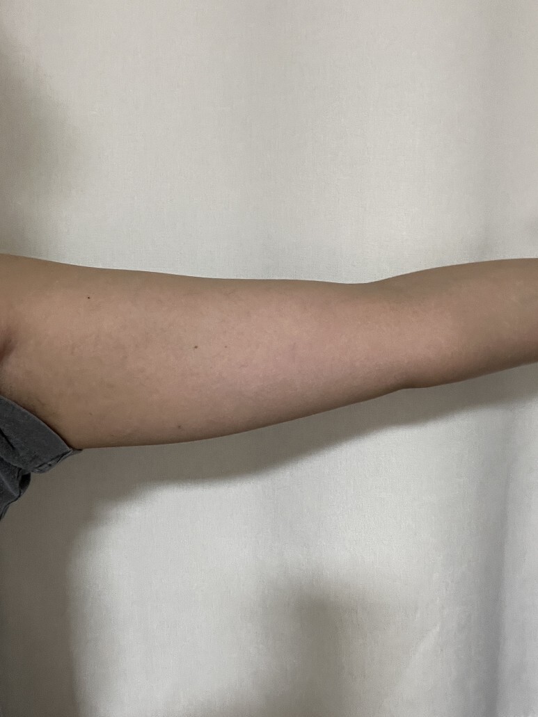 팔뚝 지방분해 주사 후기