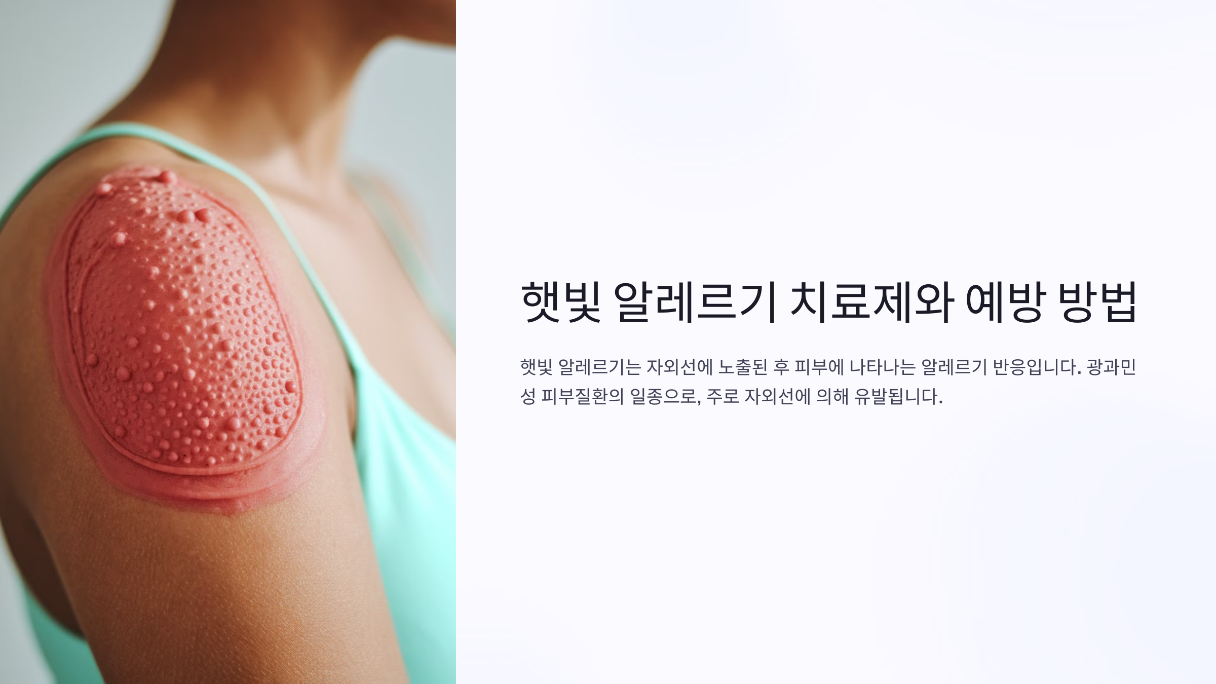 햇빛 알레르기 치료제와 예방법