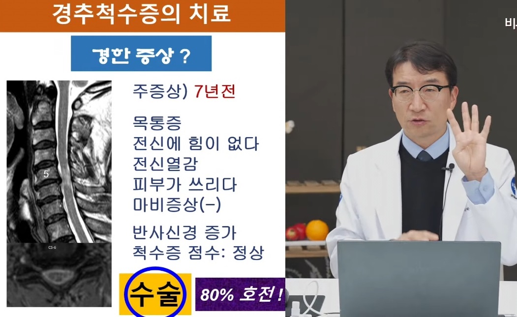 경추척수증-치료-강경중교수