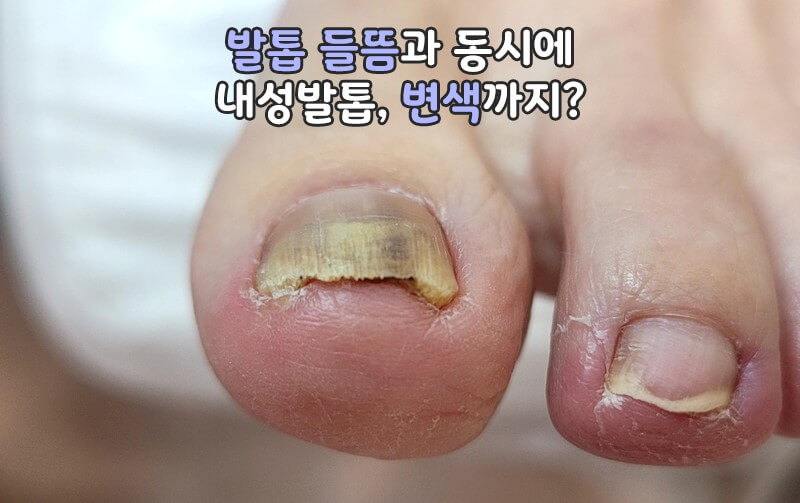 발톱무좀 모습