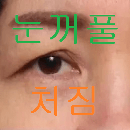 눈꺼풀 처짐이 심한 남성