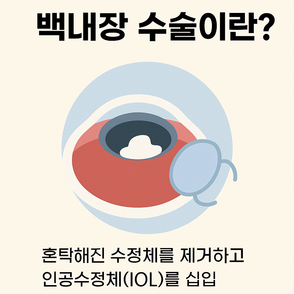 백내장 수술