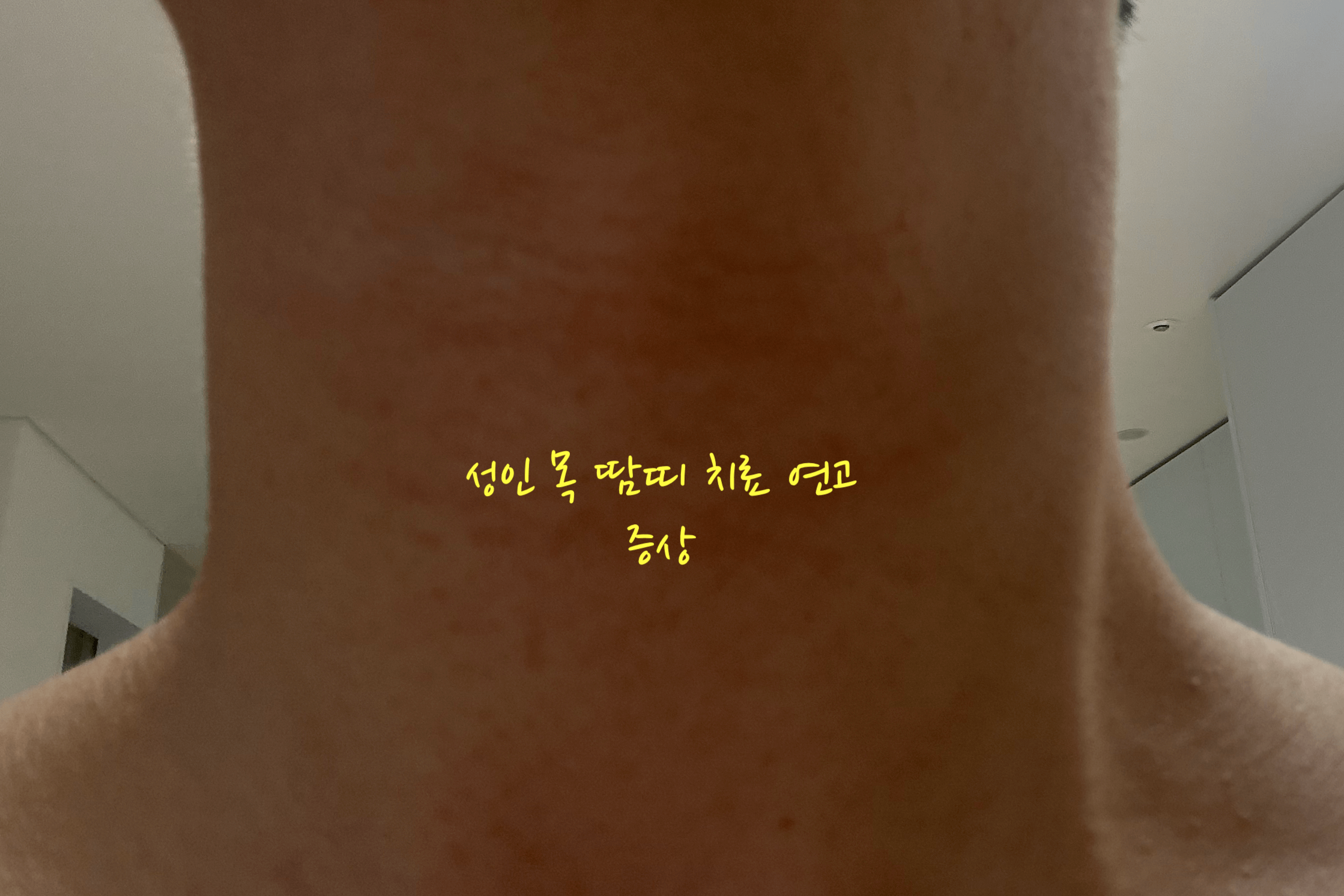 성인 목 땀띠