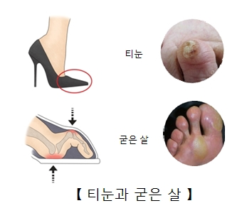 티눈과 굳은살