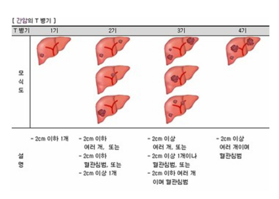 간암의 병기