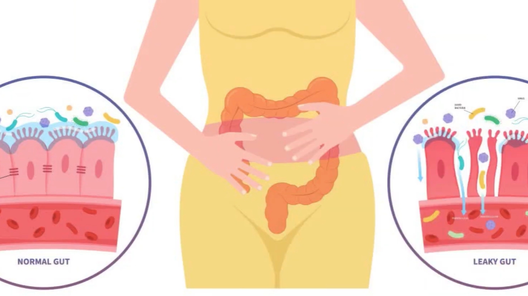 장누수증후군 증상