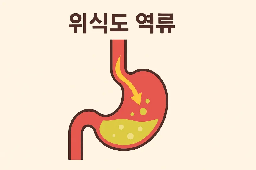 역류성 식도염 증상