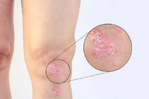 다리-무릎-건선